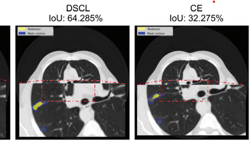 Precision in Medical Segmentation with Compound Loss Functions