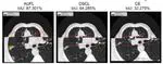 Advancing precision in medical image segmentation: A performance analysis of loss functions for COVID-19 lung infection segmentation in computed tomography images